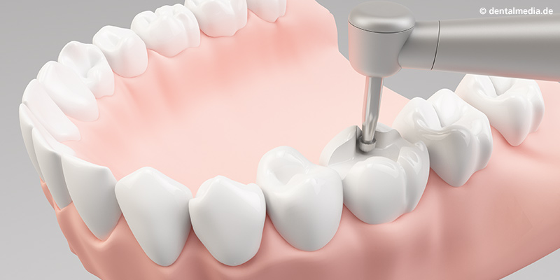 Inlays : Entfernung der Karies. Präparieren des Zahnes